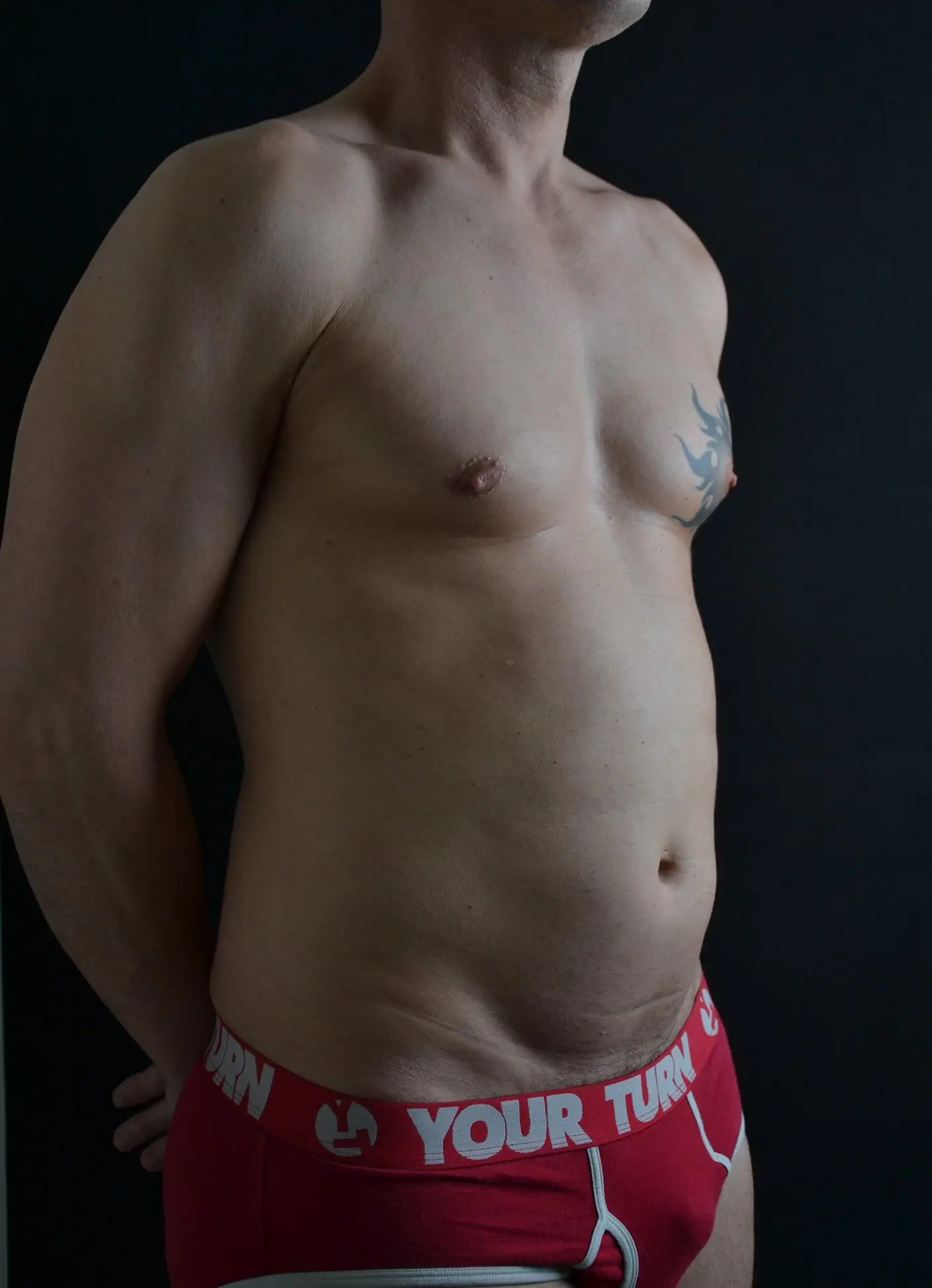 Lipoescultura de alta definición en hombres - antes