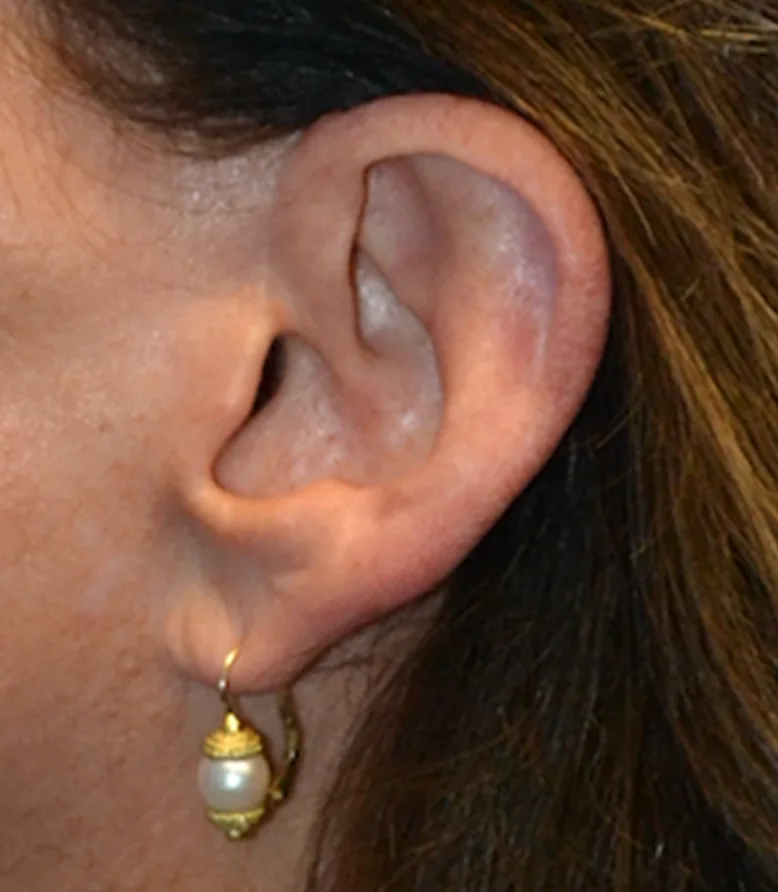 Cicatrices después de lifting facial