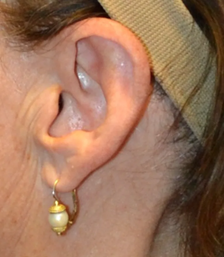 Cicatrices lifting facial