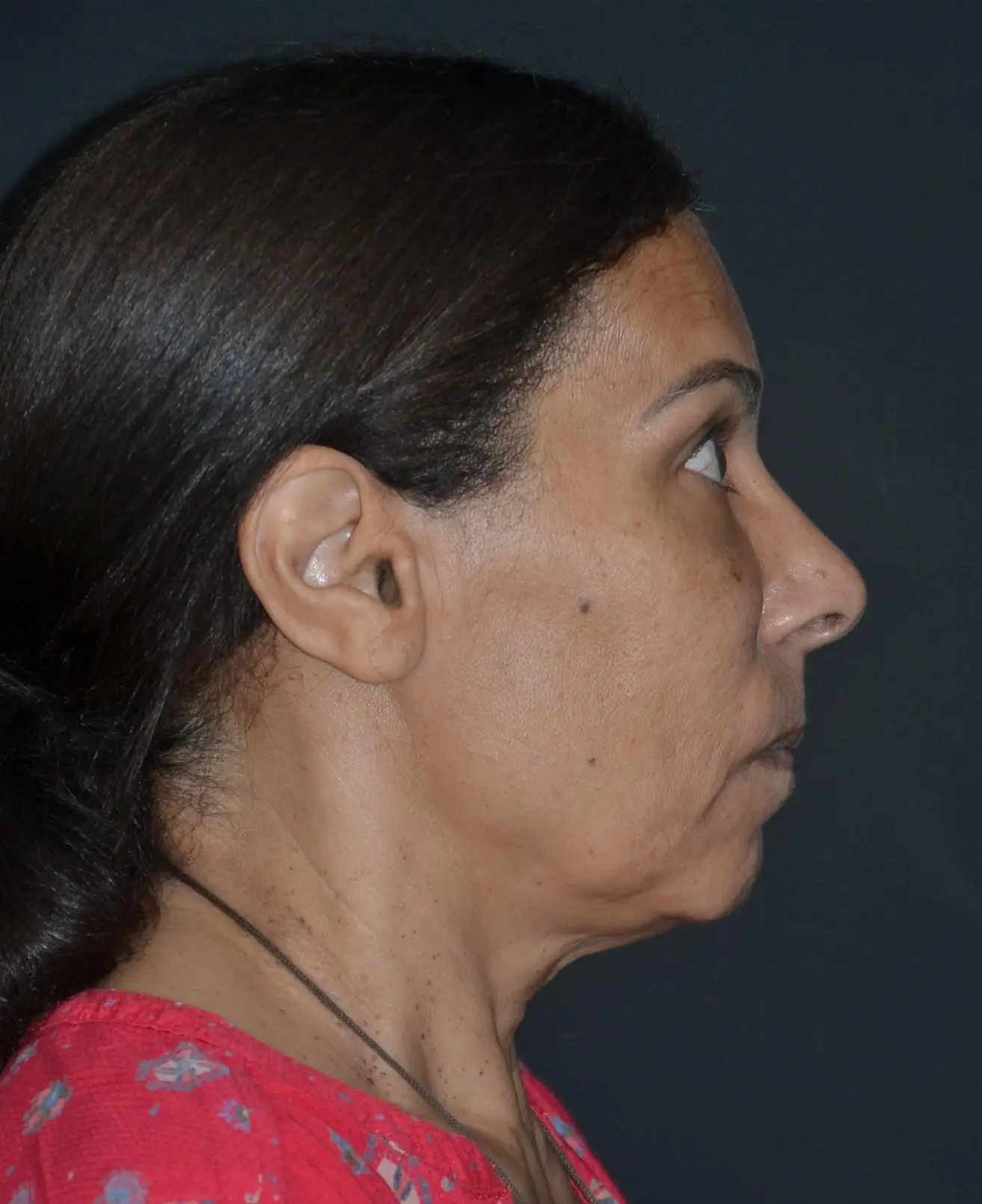 Lifting facial - antes
