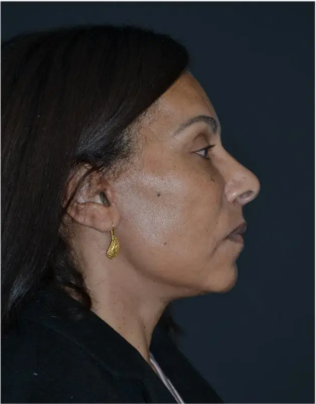 Lifting facial - después