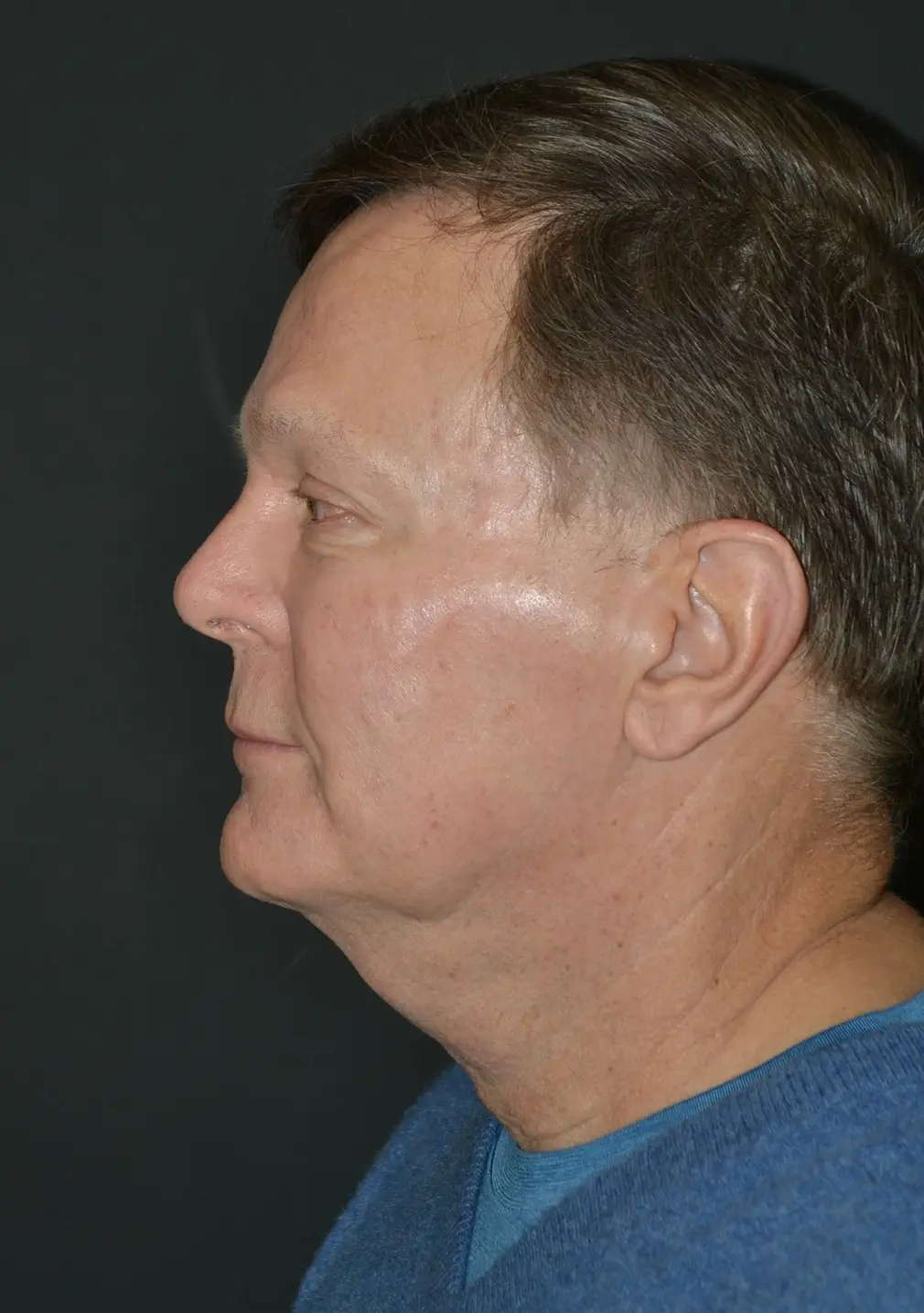 Lifting facial en hombres - antes