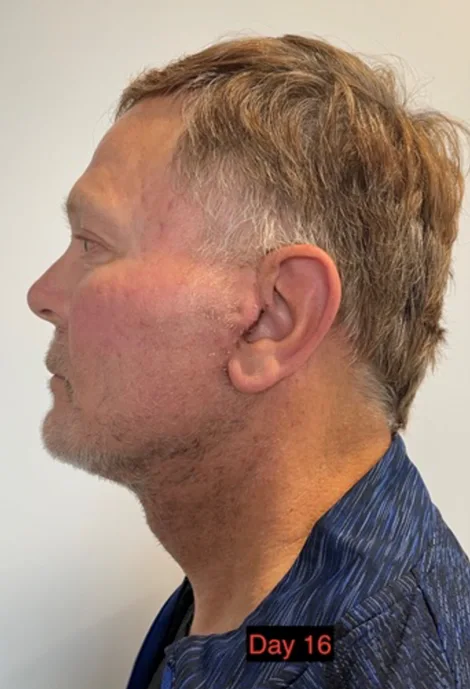 Lifting facial en hombres - después