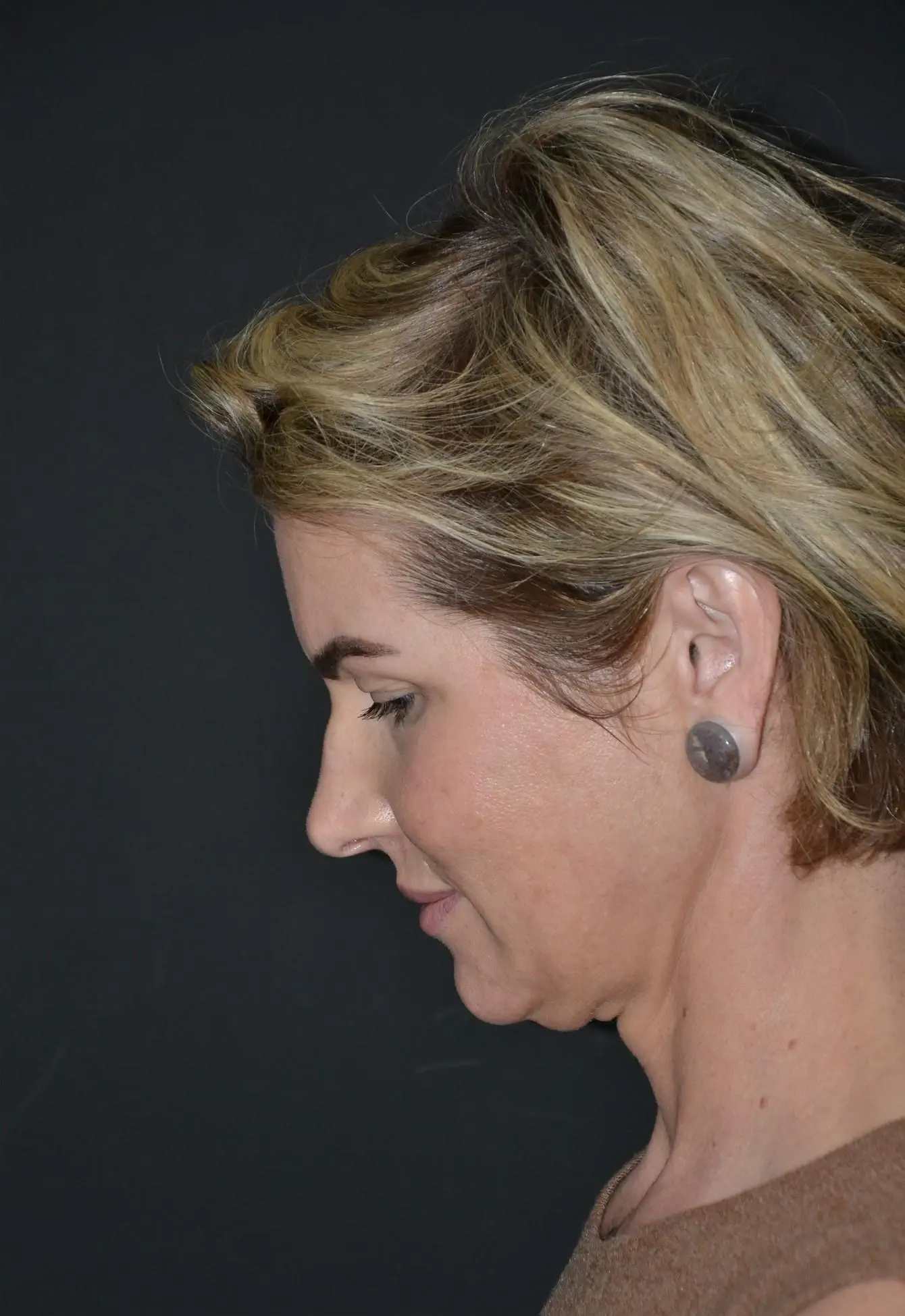 Lifting facial en mujer - antes