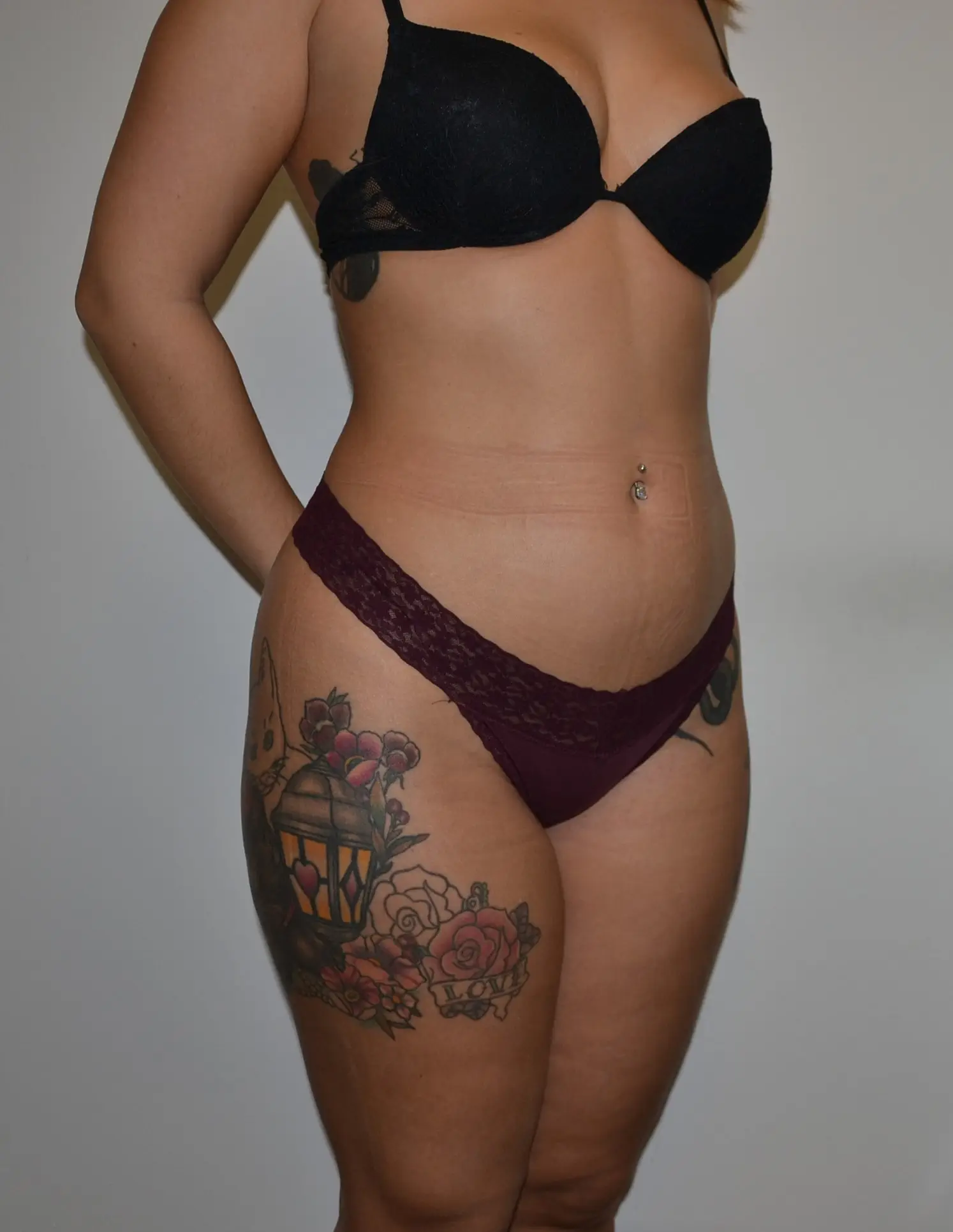 Abdominoplastia vs lipoescultura - antes