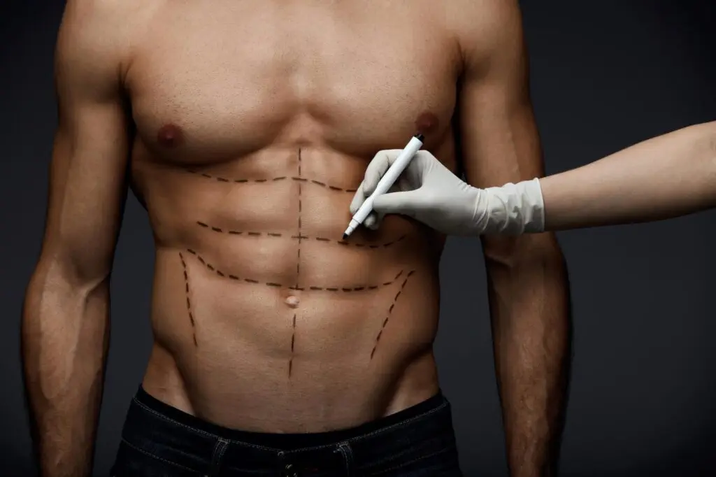 Tipos de liposucción