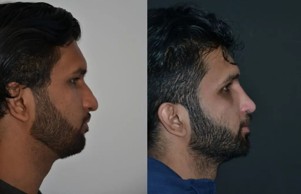 Rinoplastia en hombres