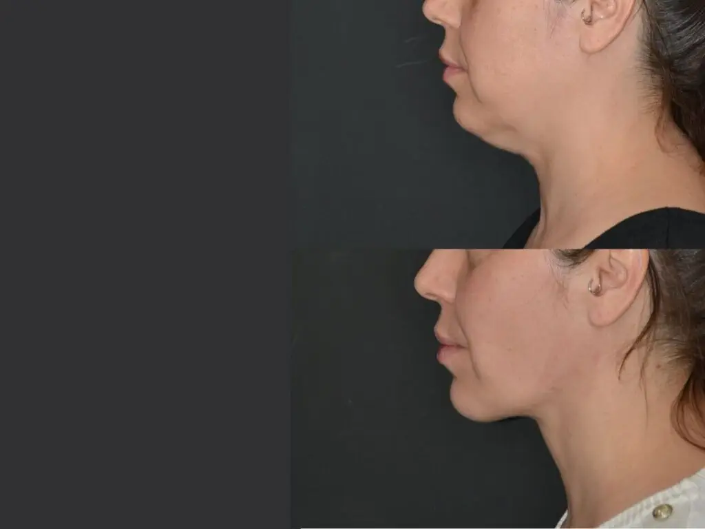 Neck sagging