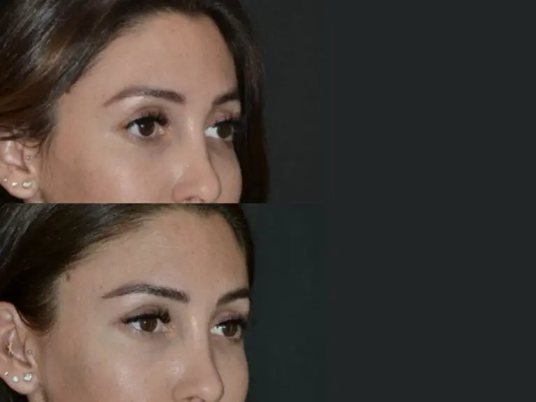 Foxy eyes cirugia