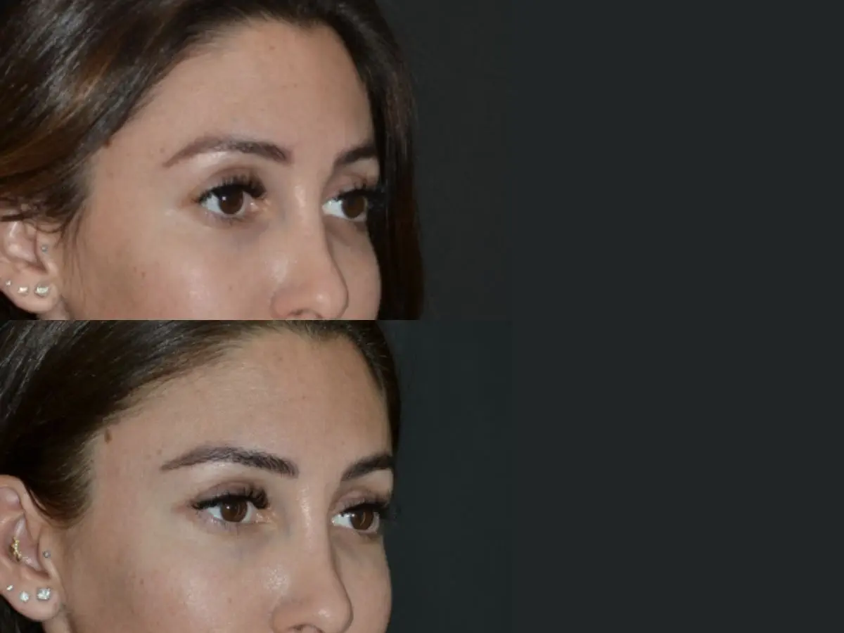 Blog Foxy eyes cirugia