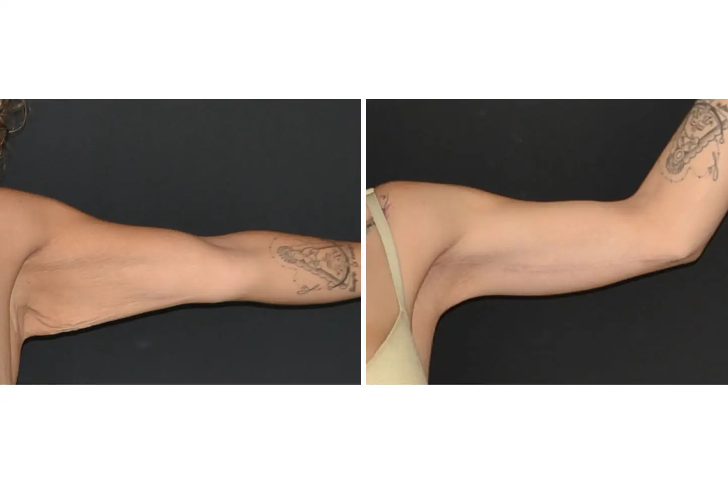 brachioplasty-a1