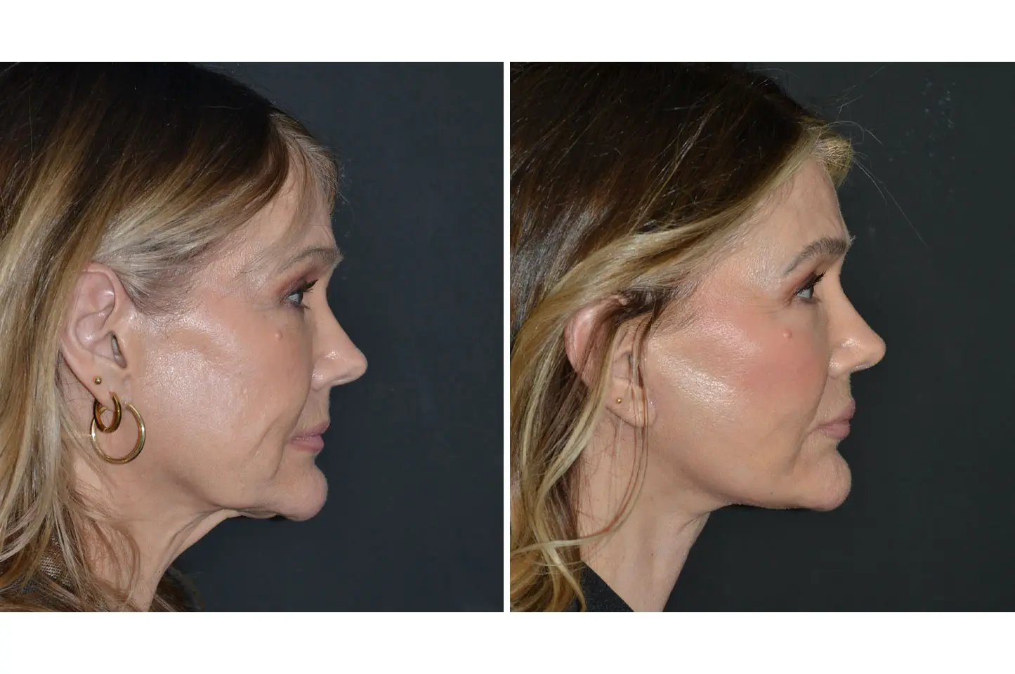 deep-plane-facelift-a2