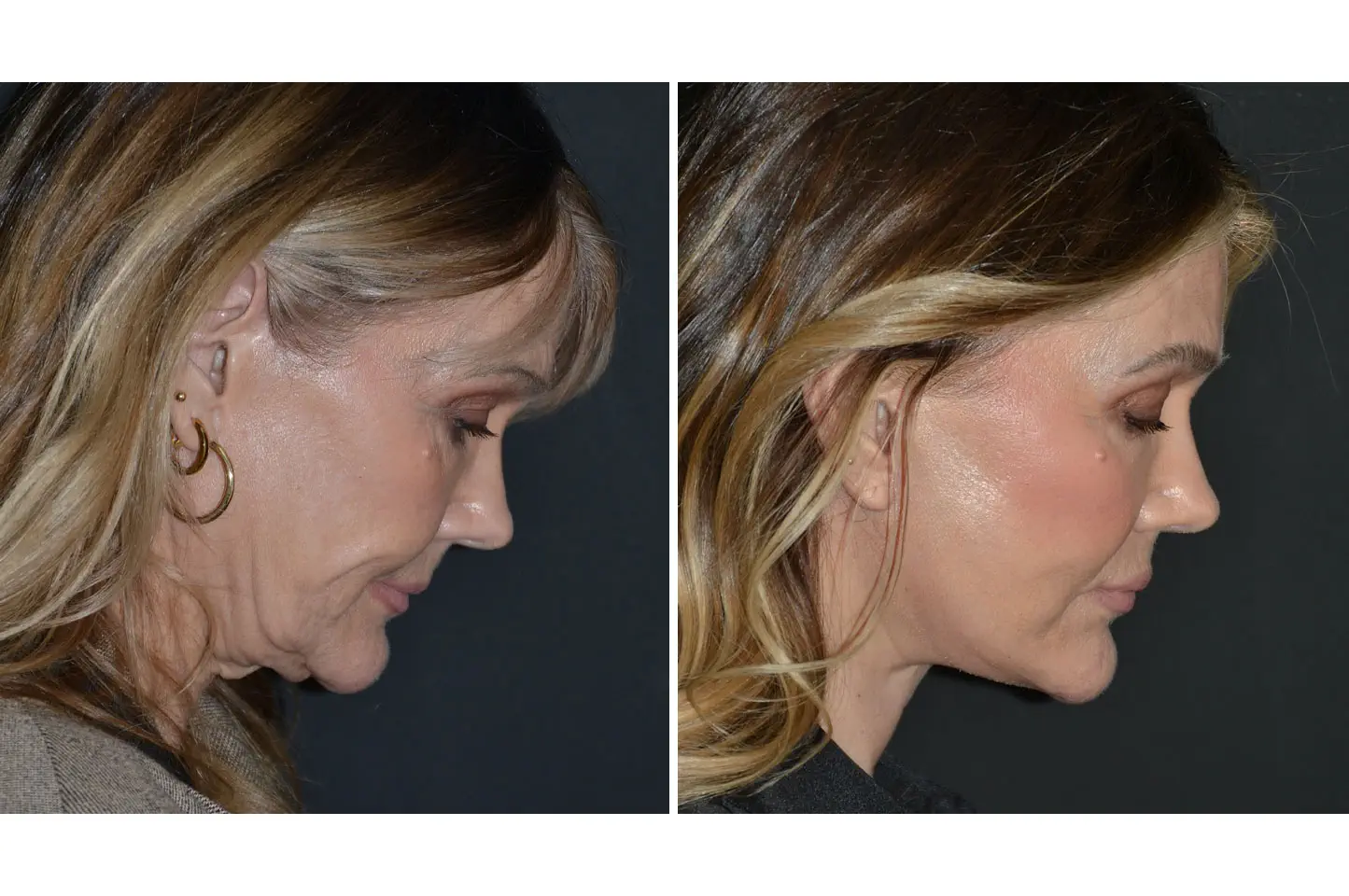 deep-plane-facelift-a3