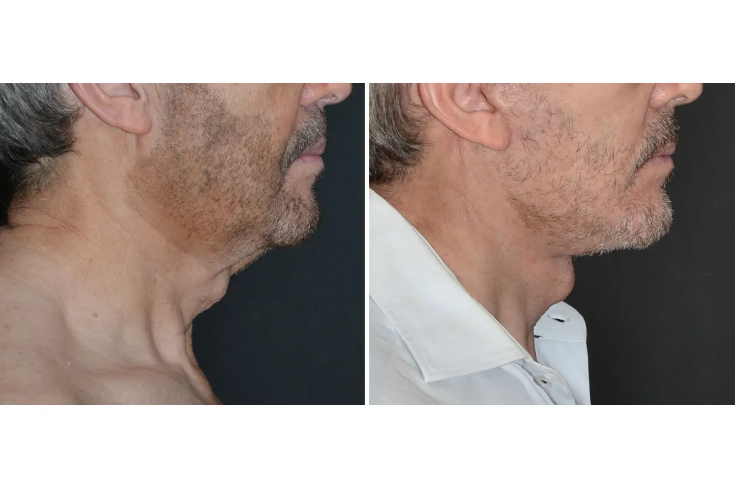 deep-plane-facelift-b1