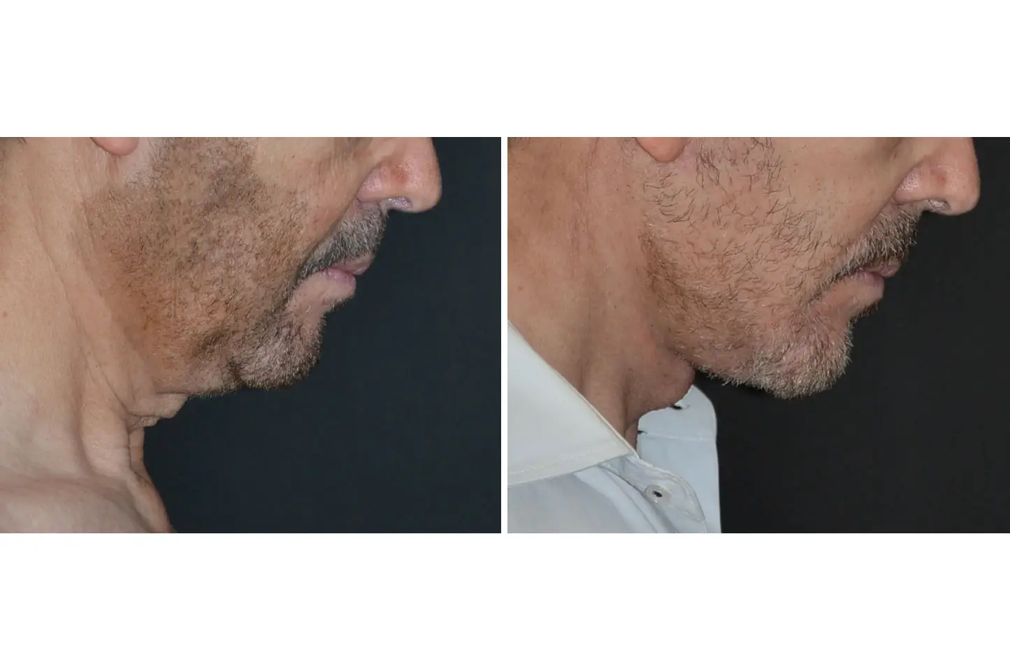 deep-plane-facelift-b2