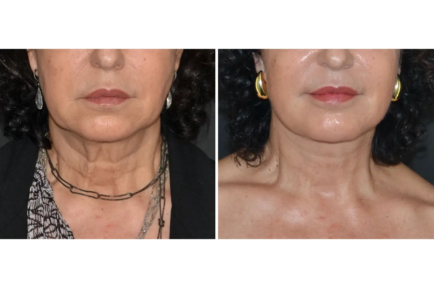 deep-plane-facelift-c1