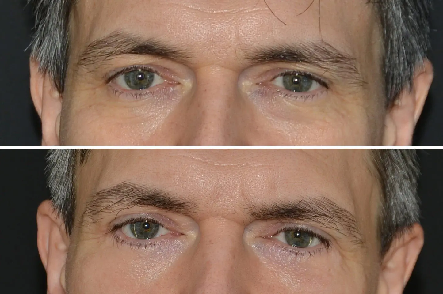 gallery-blepharoplasty-a1