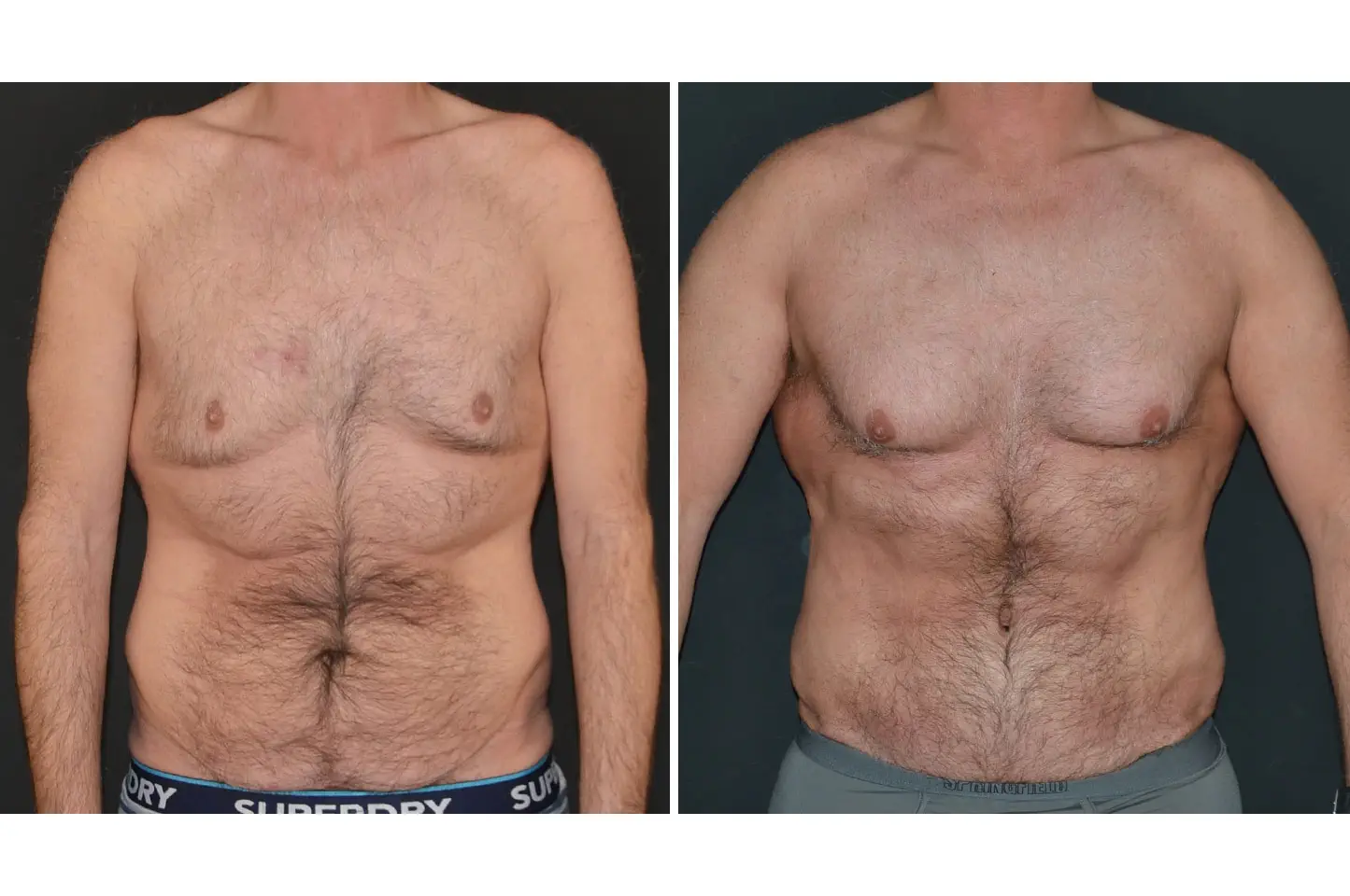 gallery-body-lift-b1