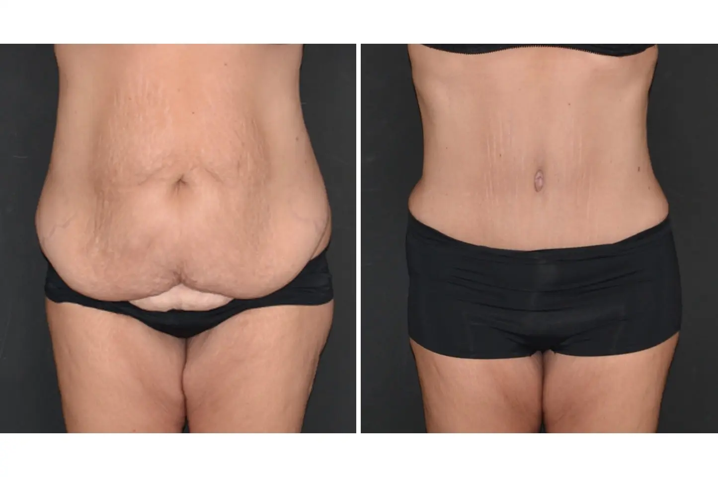 gallery-body-lift-c1