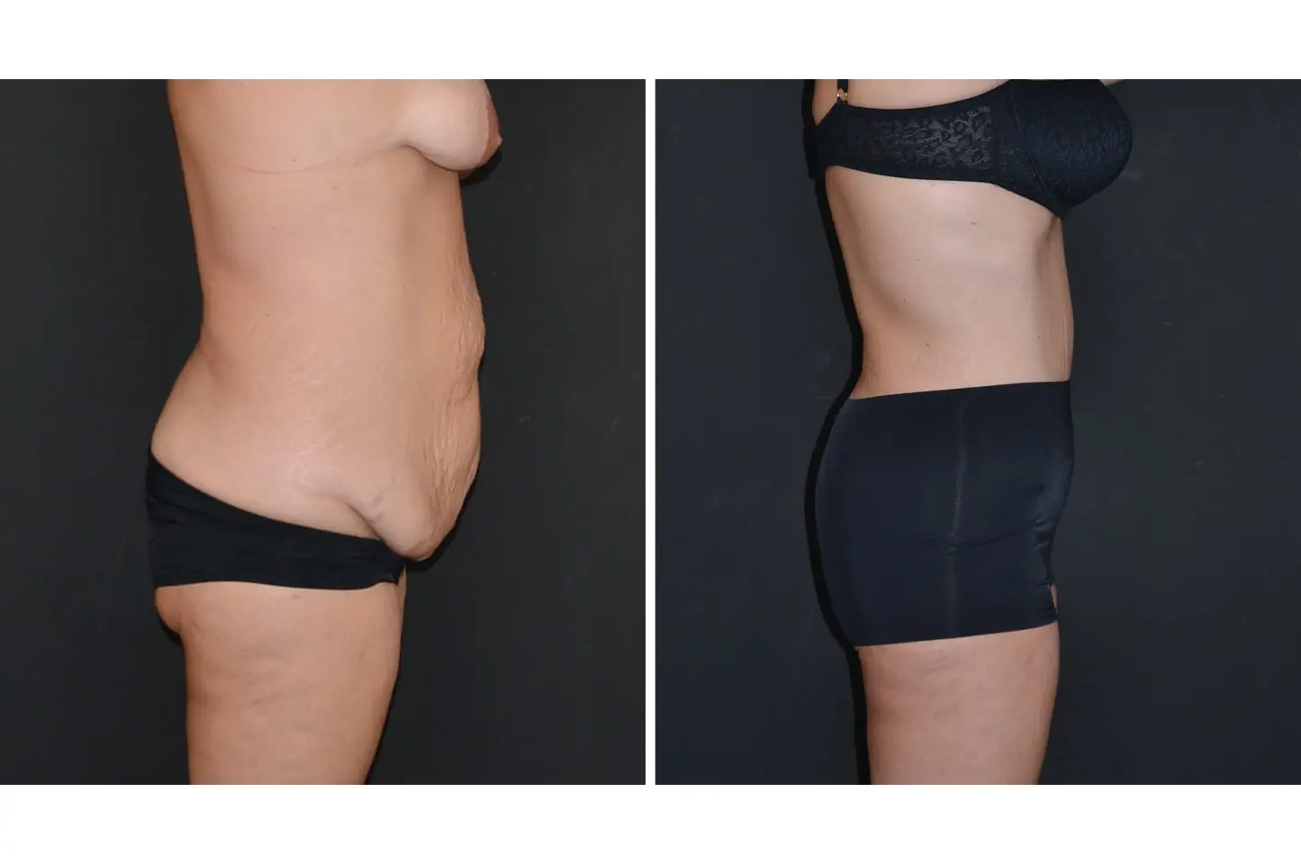 gallery-body-lift-c2