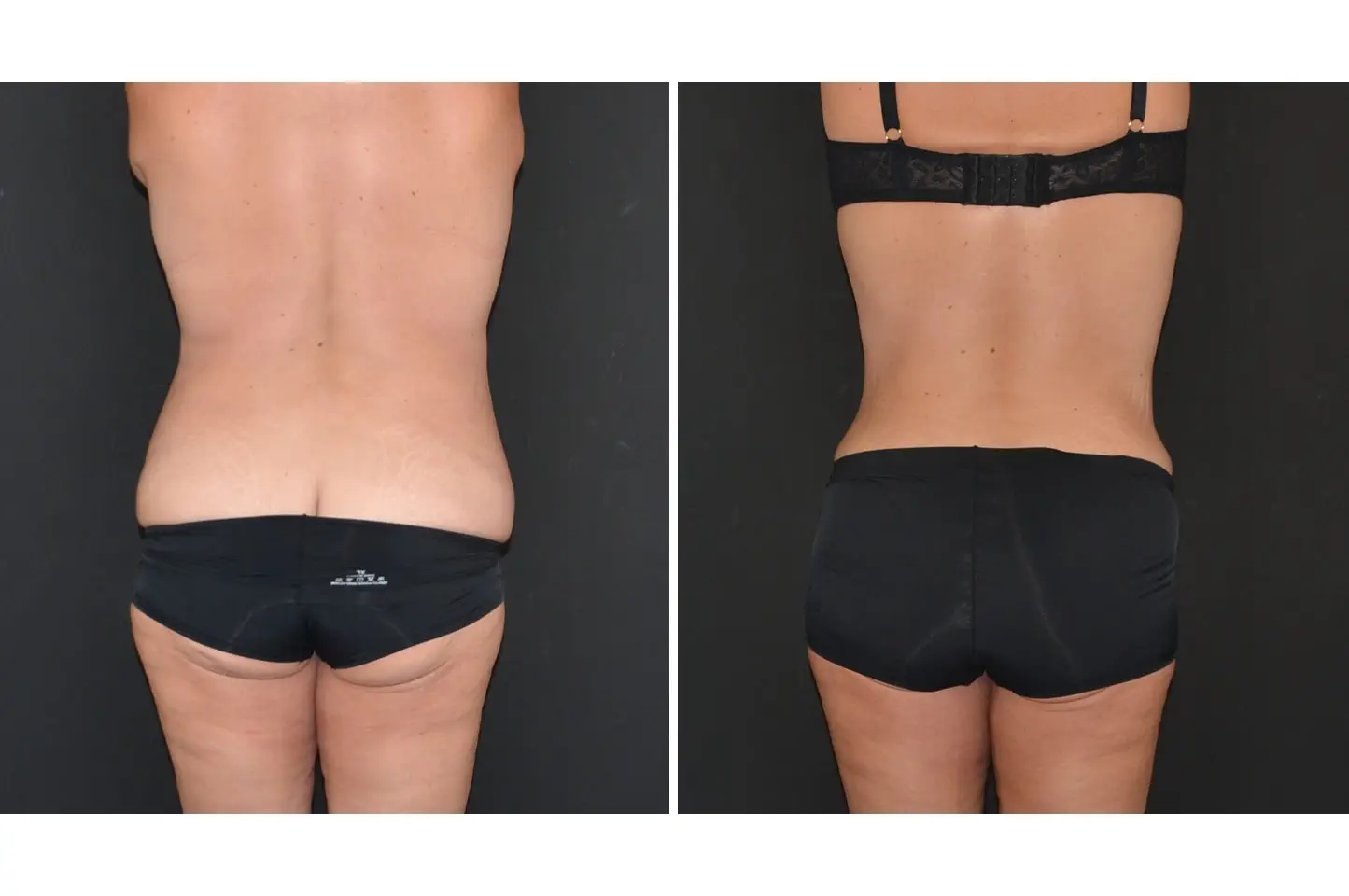 gallery-body-lift-c3