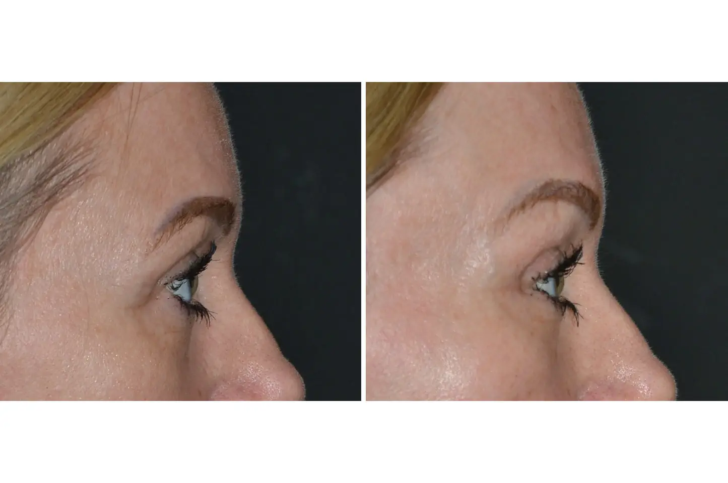gallery-brow-lift-c2