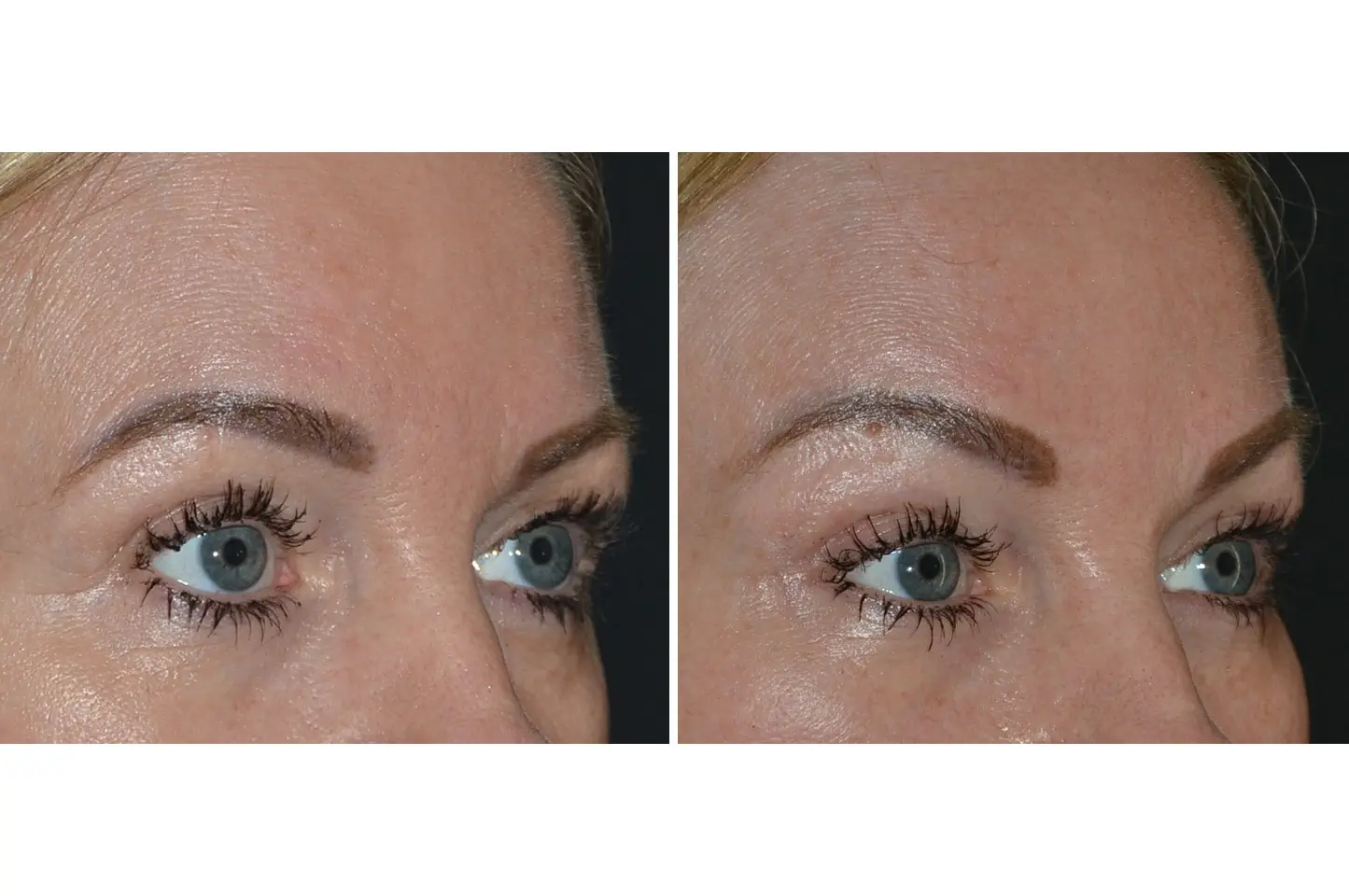 gallery-brow-lift-c3
