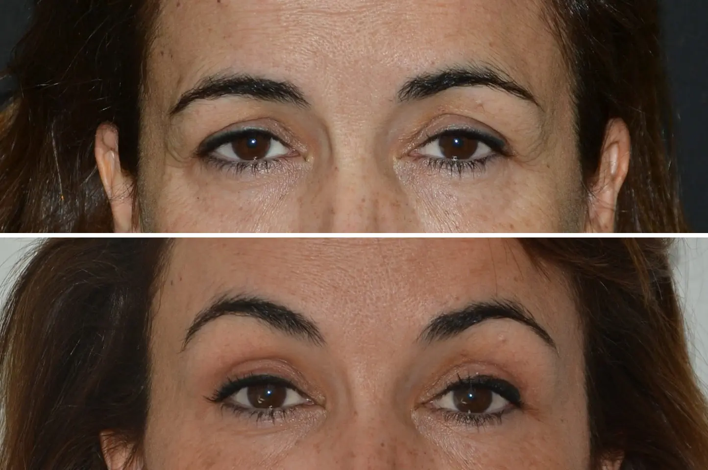 gallery-brow-lift-c4