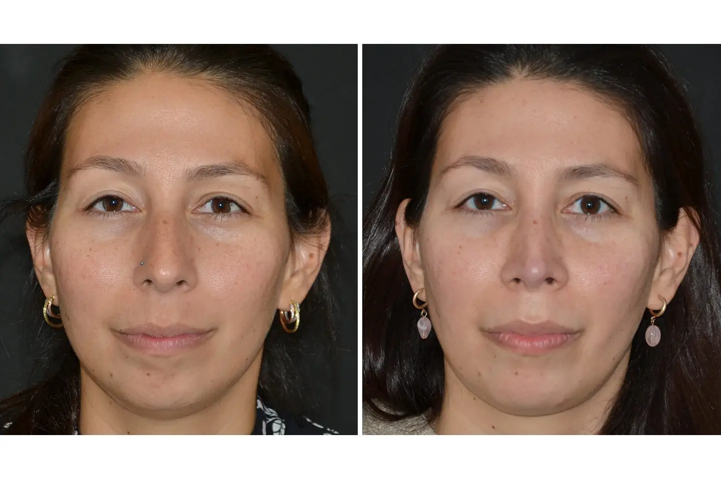 rhinoplasty-a1