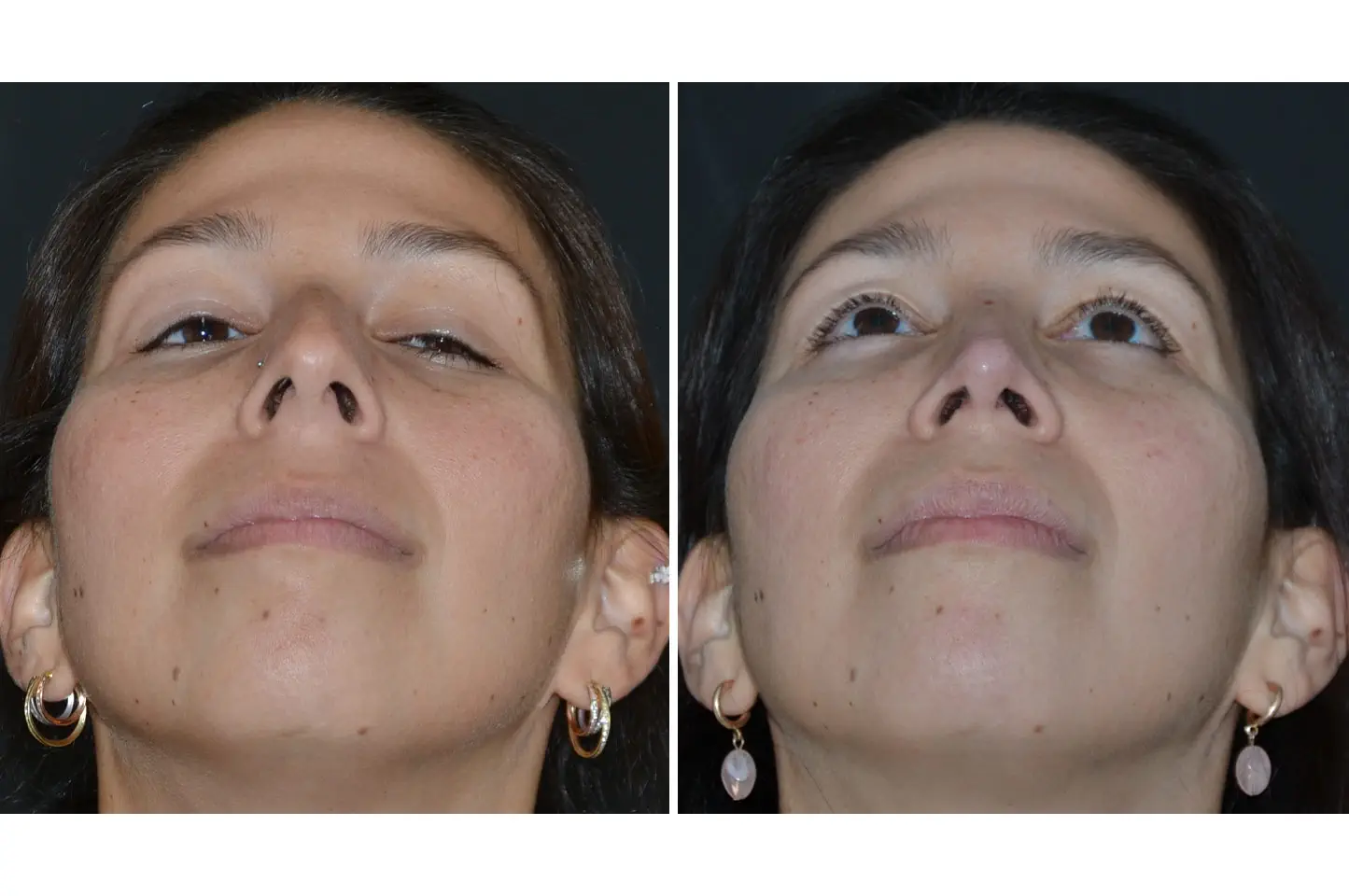 rhinoplasty-a2