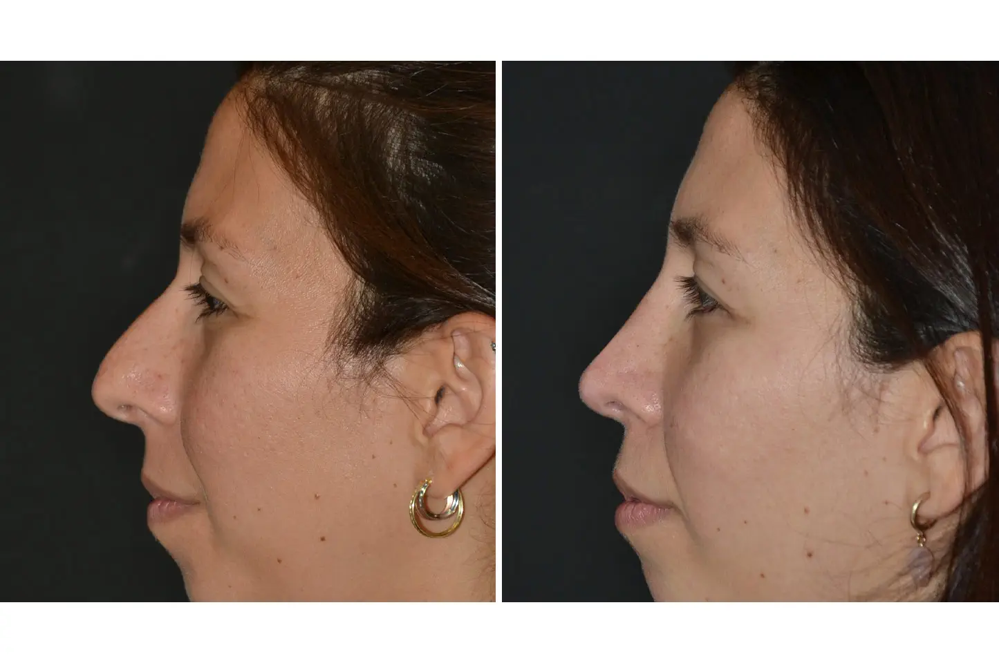 rhinoplasty-a3