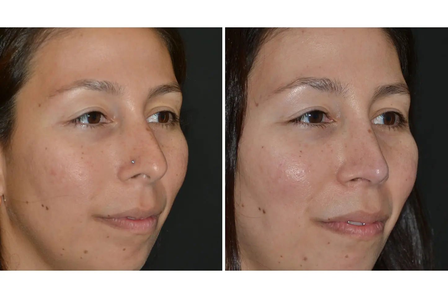 rhinoplasty-a4