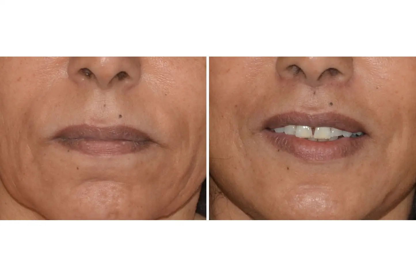 upper-lip-lift-a1