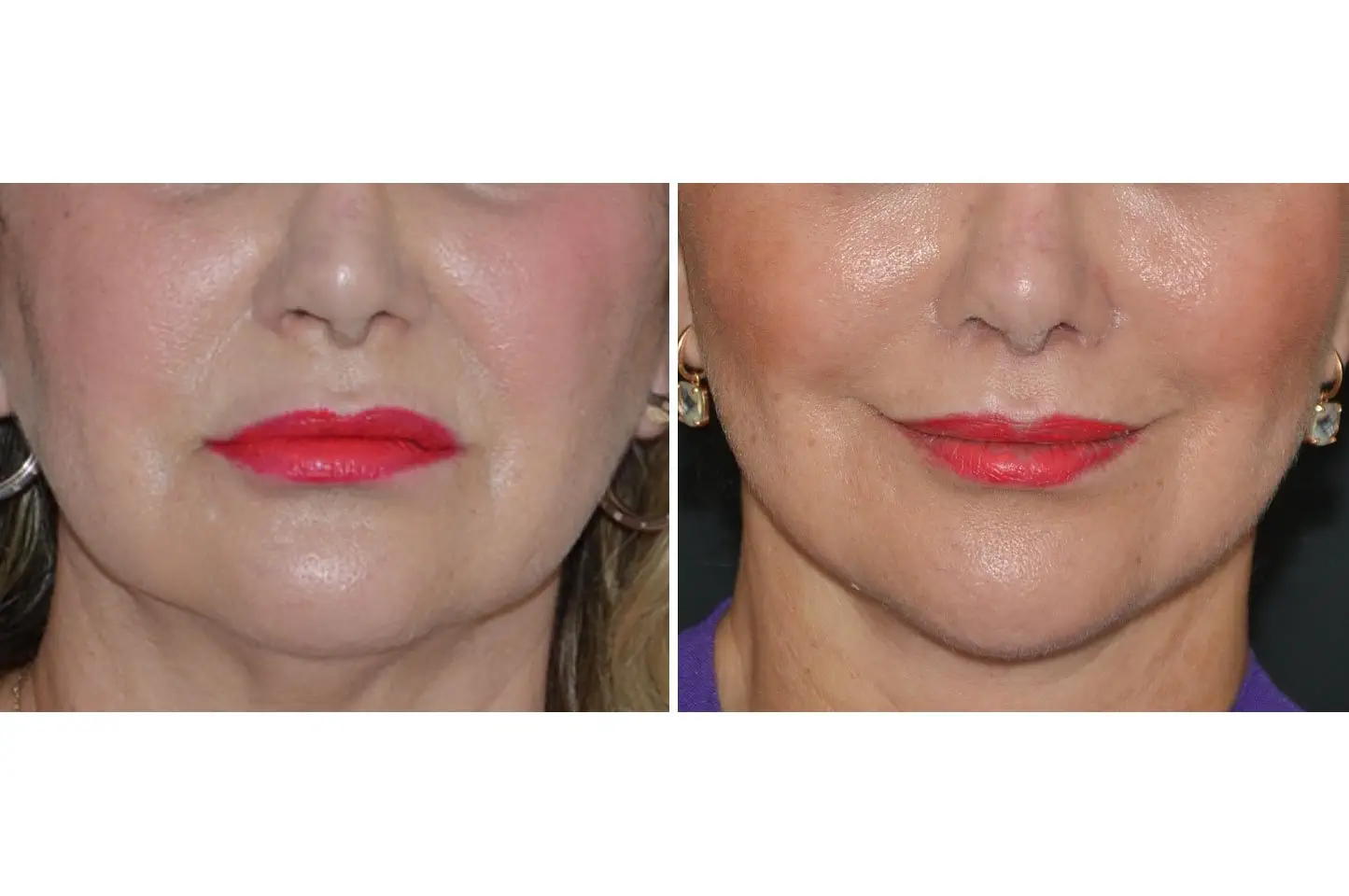 upper-lip-lift-b1