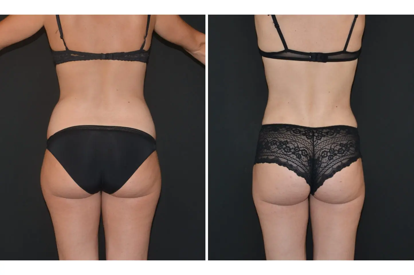 abdominoplasty-w-a2
