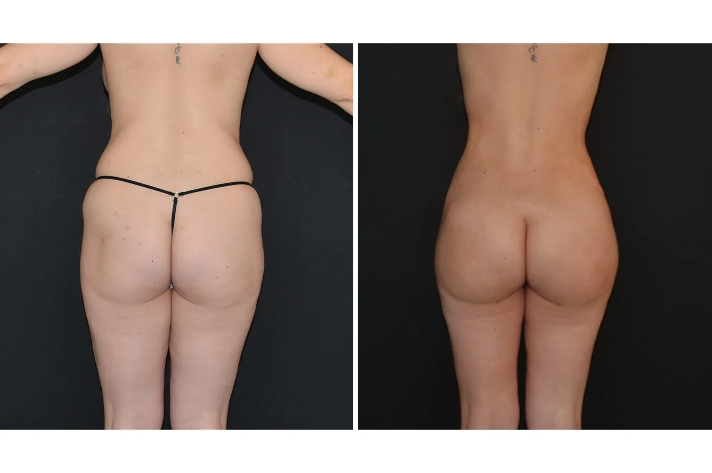 Brazilian Butt Lift bbl-woman-a2
